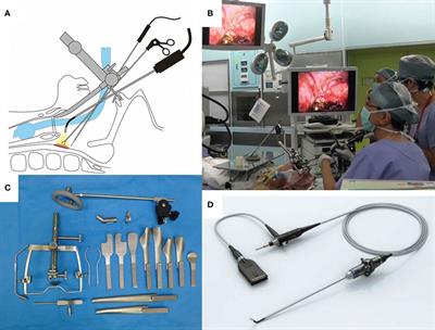 Current Status of Transoral Surgery for Patients With Early-Stage Pharyngeal and Laryngeal Cancers in Japan